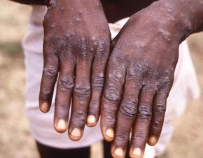 Centers for Disease Control via Reuters, FILE