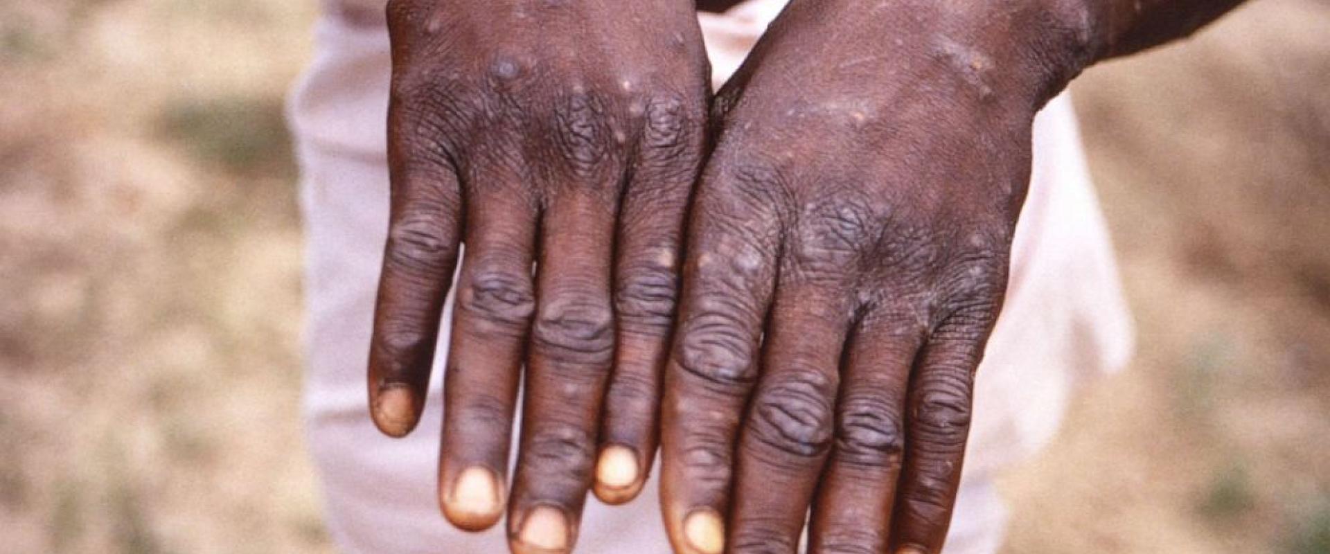 Centers for Disease Control via Reuters, FILE
