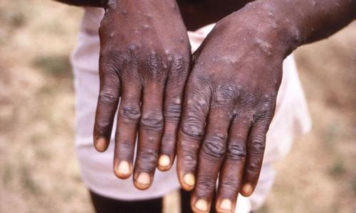 Centers for Disease Control via Reuters, FILE