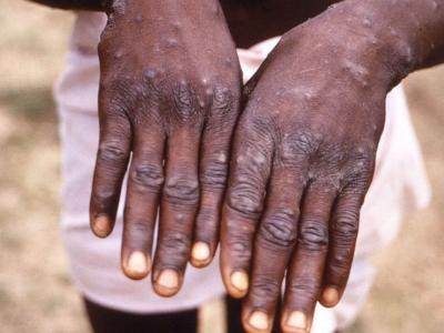 Centers for Disease Control via Reuters, FILE